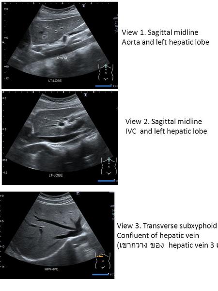 View 1. Sagittal midline Aorta and left hepatic lobe