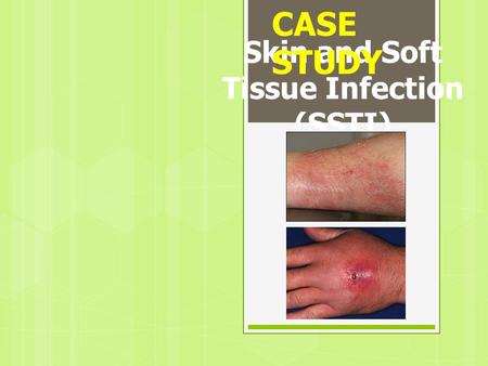 Skin and Soft Tissue Infection (SSTI)