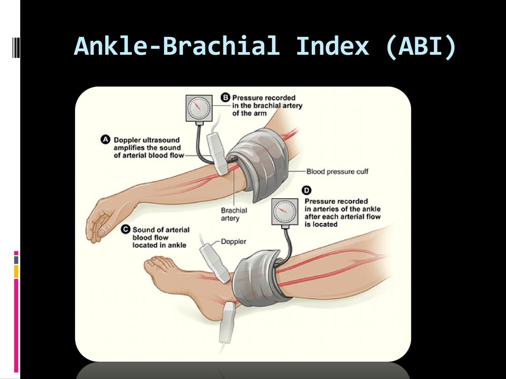 Ankle-Brachial Index (ABI)