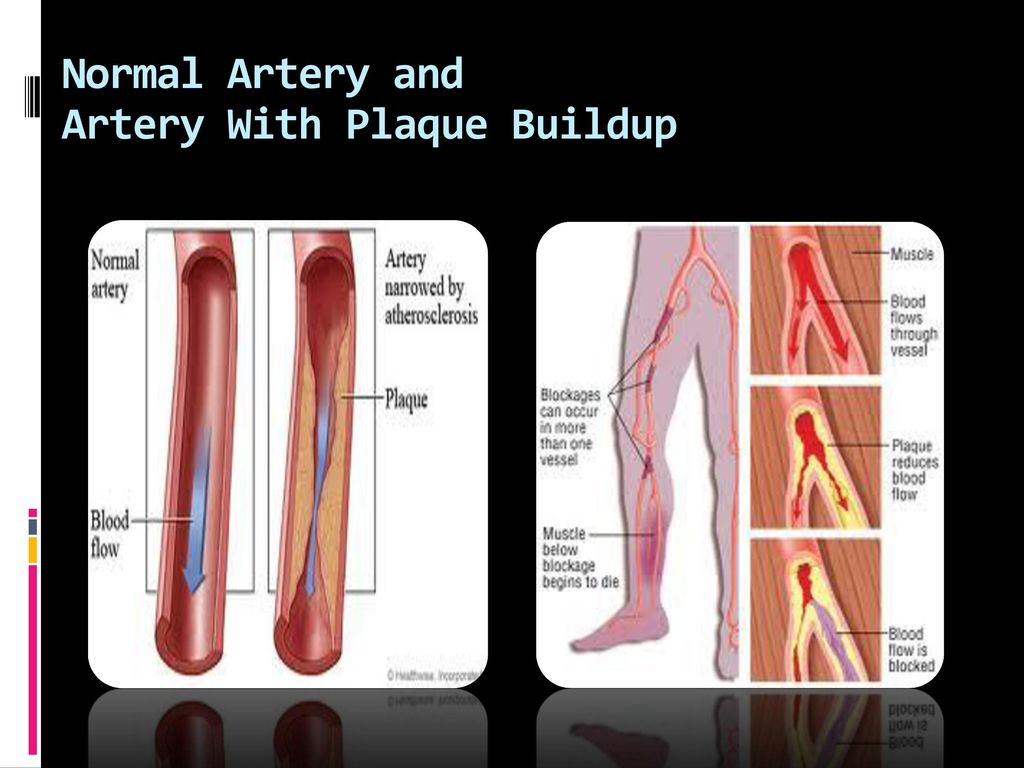 Normal Artery and Artery With Plaque Buildup