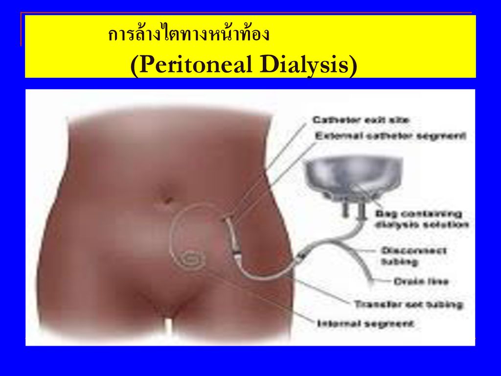 การล้างไตทางหน้าท้อง (Peritoneal Dialysis)