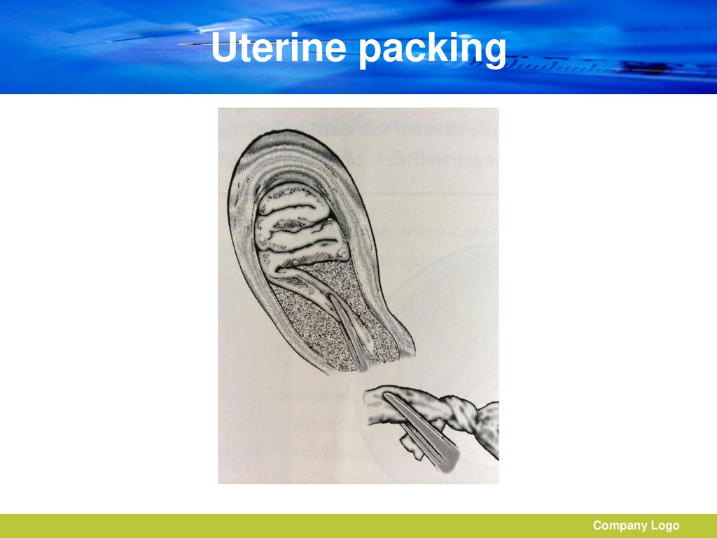 Uterine packing Company Logo