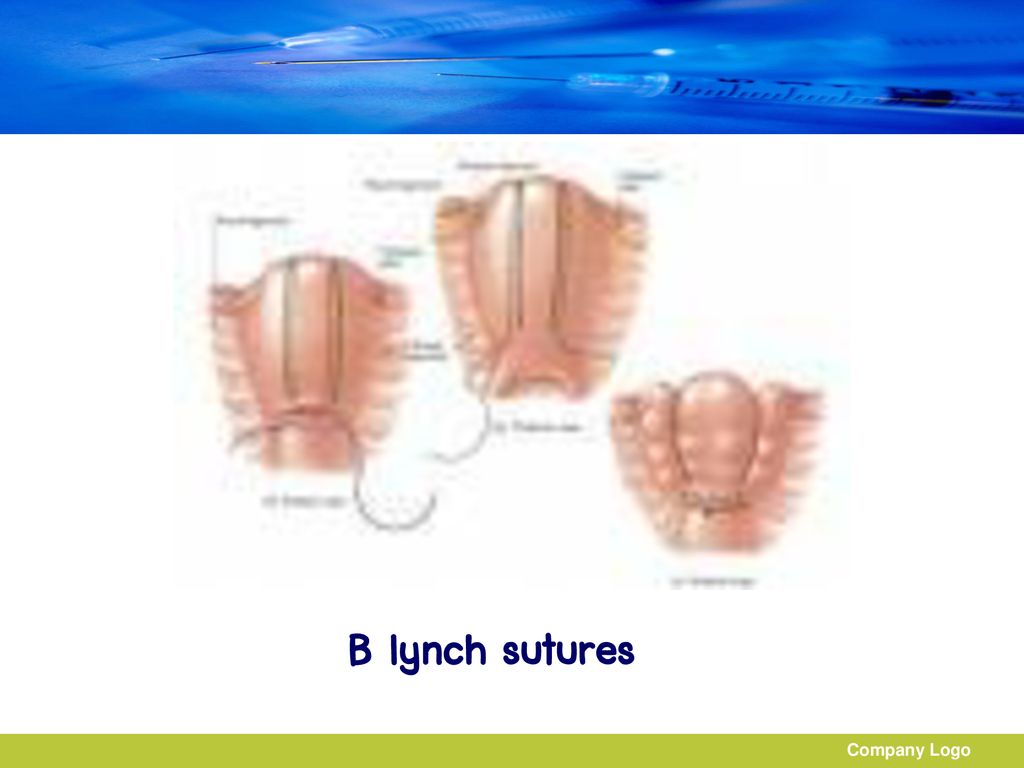 B lynch sutures Company Logo