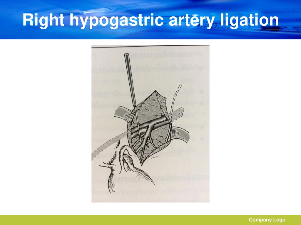 Right hypogastric artery ligation