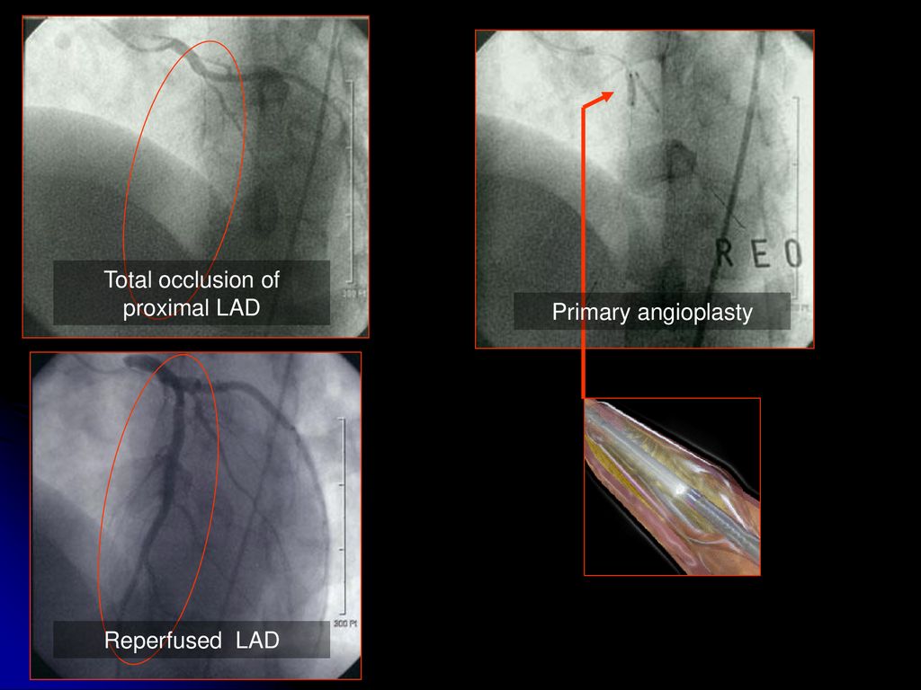 Total occlusion of proximal LAD