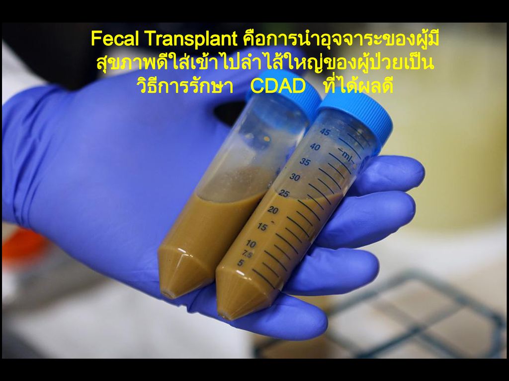 Fecal Transplant คือการนำอุจจาระของผู้มีสุขภาพดีใส่เข้าไปลำไส้ใหญ่ของผู้ป่วยเป็นวิธีการรักษา CDAD ที่ได้ผลดี