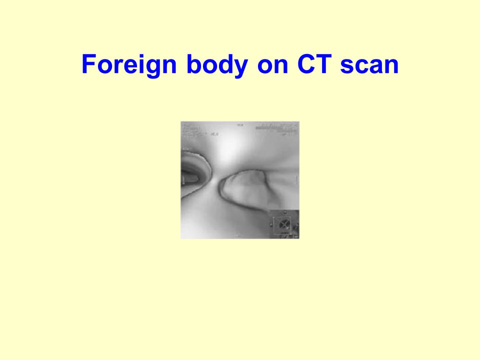 Foreign body on CT scan