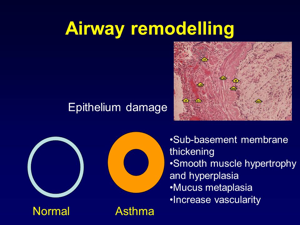 Airway remodelling Epithelium damage Normal Asthma