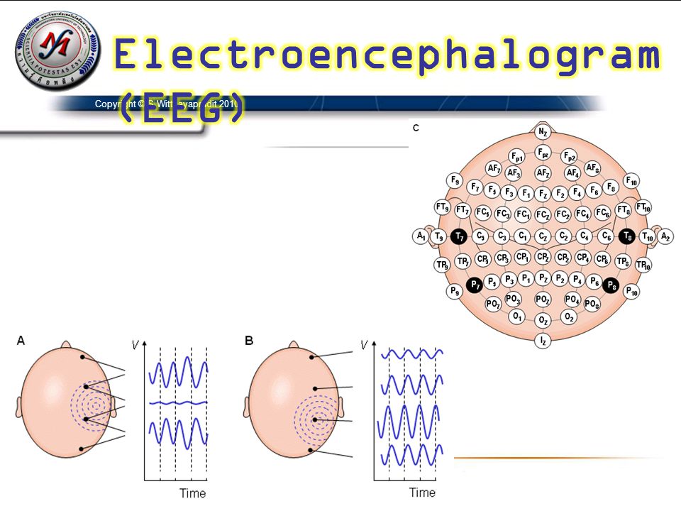 Electroencephalogram(EEG)