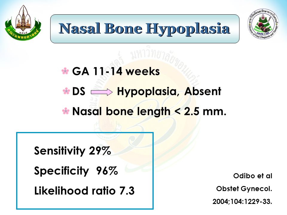 Nasal Bone Hypoplasia GA weeks DS Hypoplasia, Absent