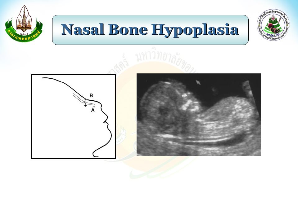 Nasal Bone Hypoplasia
