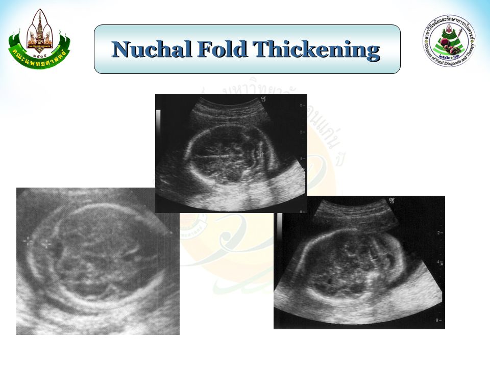 Nuchal Fold Thickening