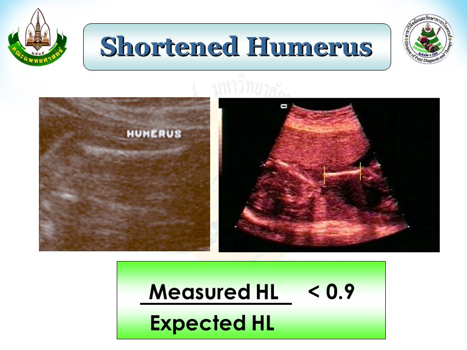Shortened Humerus Measured HL Expected HL < 0.9
