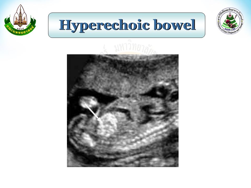 Hyperechoic bowel