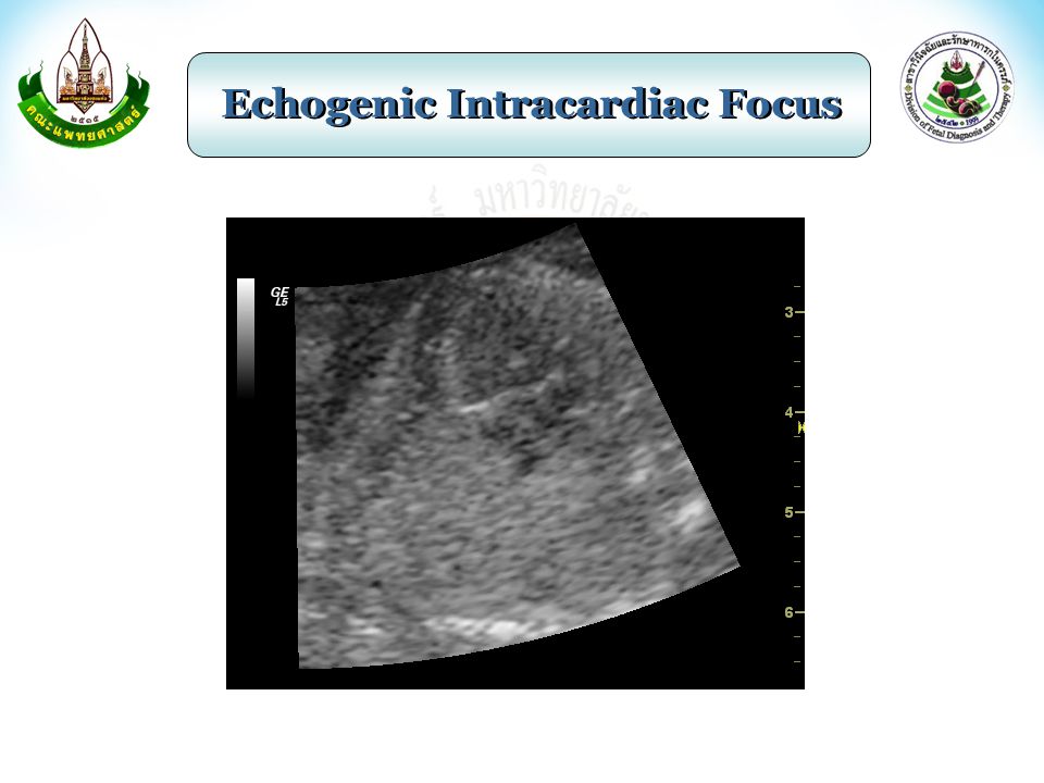 Echogenic Intracardiac Focus