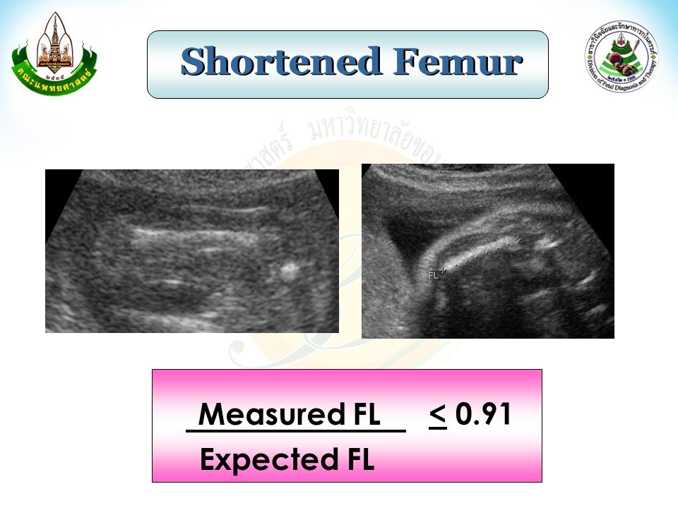 Shortened Femur Measured FL Expected FL < 0.91