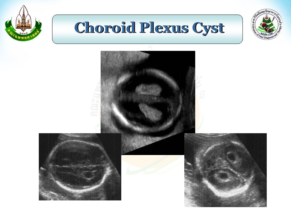 Choroid Plexus Cyst