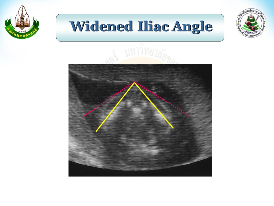 Widened Iliac Angle