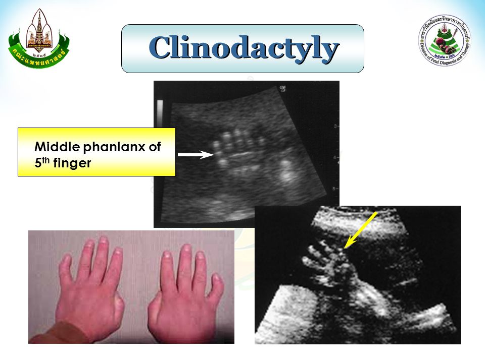 Clinodactyly Middle phanlanx of 5th finger