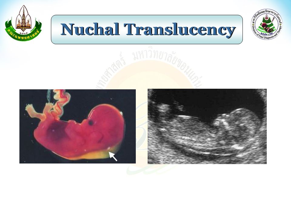Nuchal Translucency