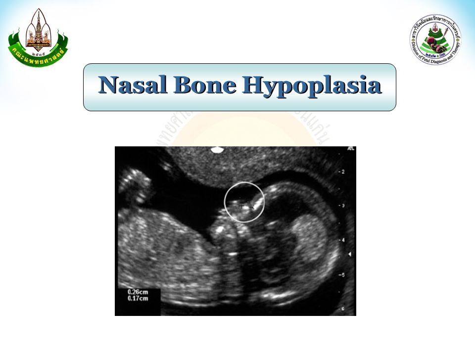 Nasal Bone Hypoplasia