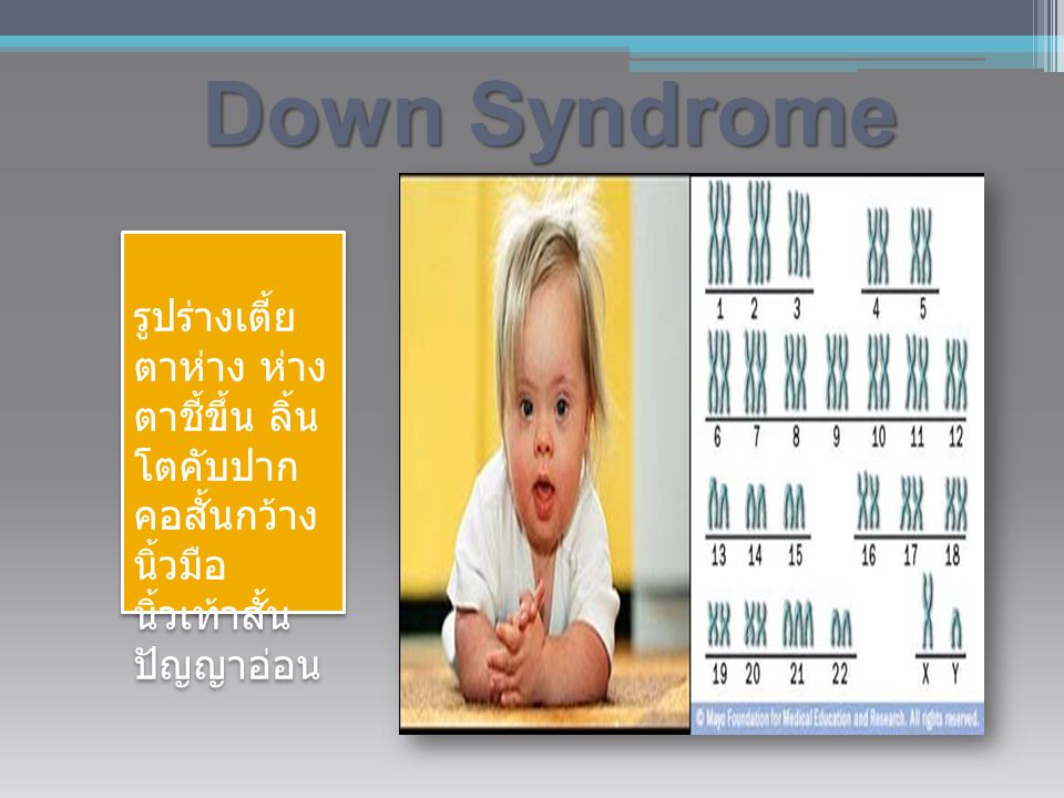 Down Syndrome รูปร่างเตี้ย ตาห่าง ห่างตาชี้ขึ้น ลิ้นโตคับ ปาก คอ สั้นกว้าง นิ้วมือ นิ้วเท้าสั้น ปัญญาอ่อน.