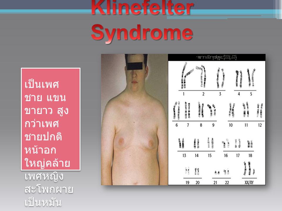 Klinefelter Syndrome เป็นเพศ ชาย แขน ขายาว สูง กว่าเพศ ชายปกติ หน้าอก ใหญ่คล้าย เพศหญิง สะโพกผาย เป็นหมัน.