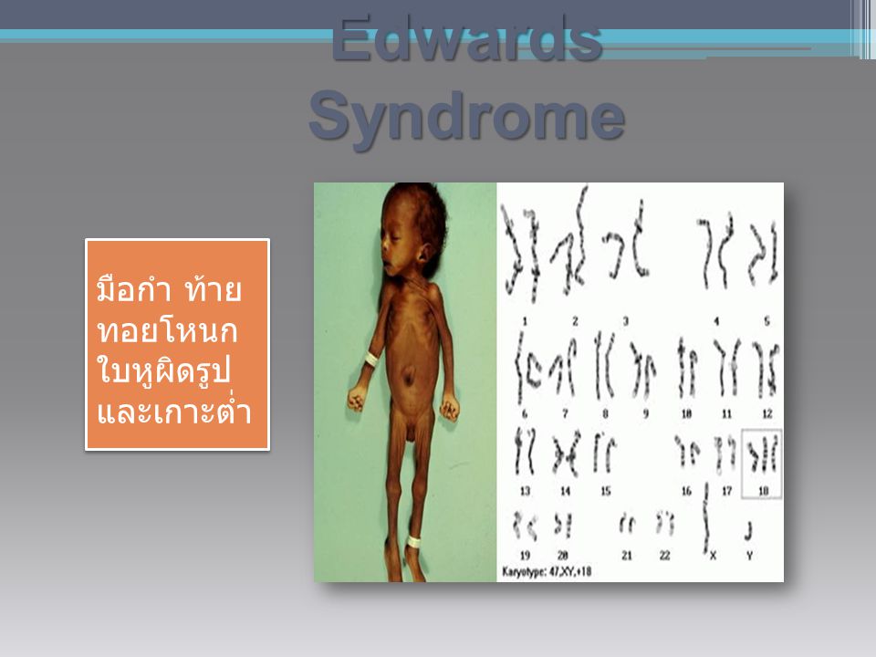 Edwards Syndrome มือกำ ท้าย ทอยโหนก ใบหูผิดรูป และเกาะต่ำ