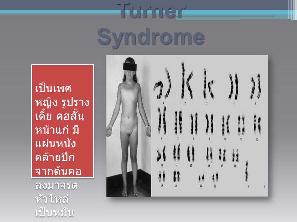 Turner Syndrome เป็นเพศ หญิง รูปร่างเตี้ย คอสั้น หน้าแก่ มี แผ่นหนัง คล้ายปีก จากต้นคอ ลงมาจรด หัวไหล่ เป็นหมัน.