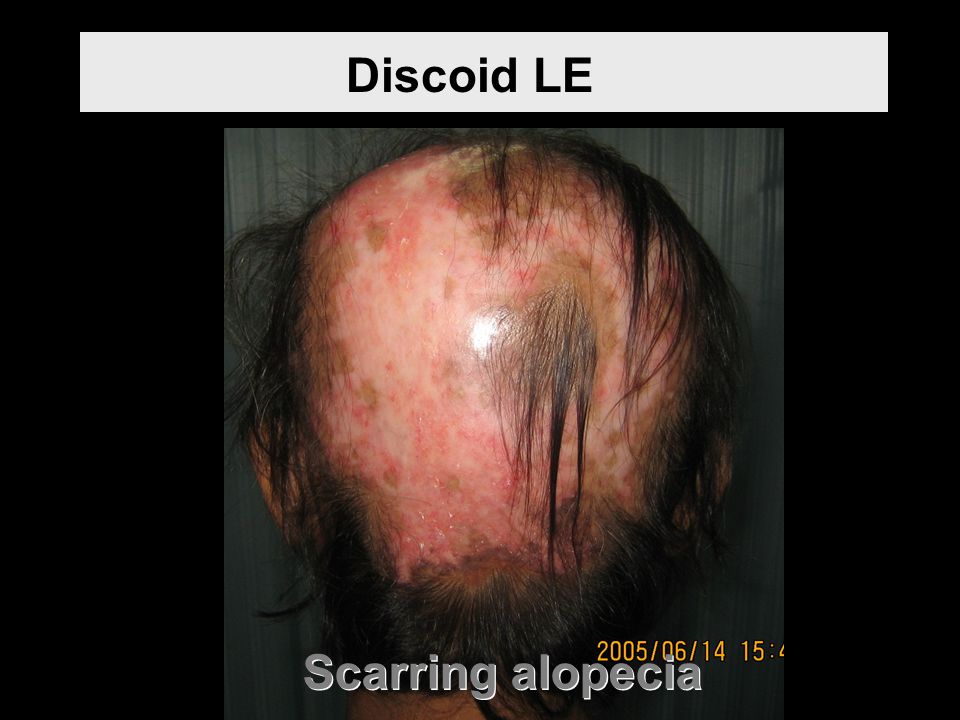 Discoid LE Scarring alopecia