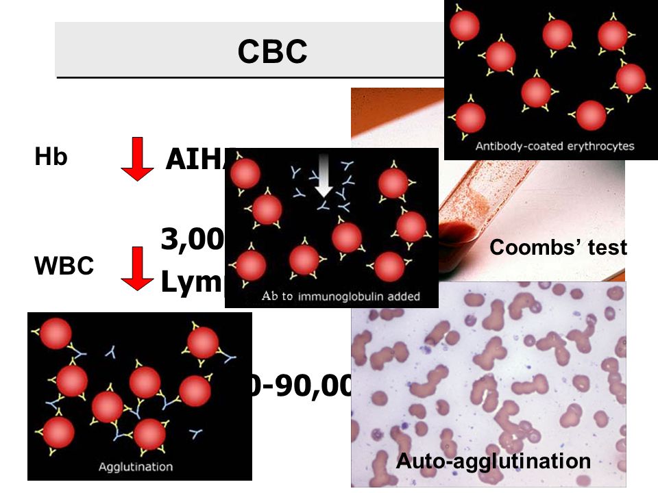 CBC AIHA 3,000-4,000 Lymph < 1,500 80,000-90,000 Hb WBC Platelet