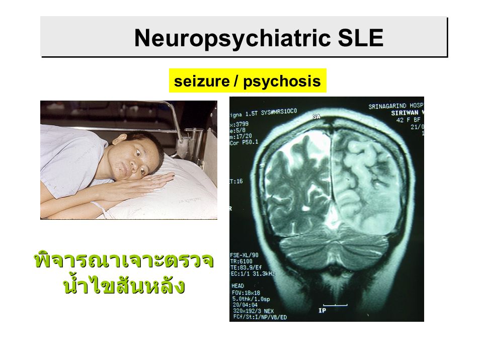 Neuropsychiatric SLE seizure / psychosis พิจารณาเจาะตรวจ น้ำไขสันหลัง