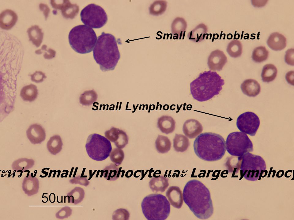 เปรียบเทียบระหว่าง Small Lymphocyte และ Large Lymphocyte