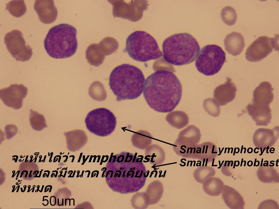 จะเห็นได้ว่า lymphoblast ทุกเซลล์มีขนาดใกล้เคียงกัน ทั้งหมด