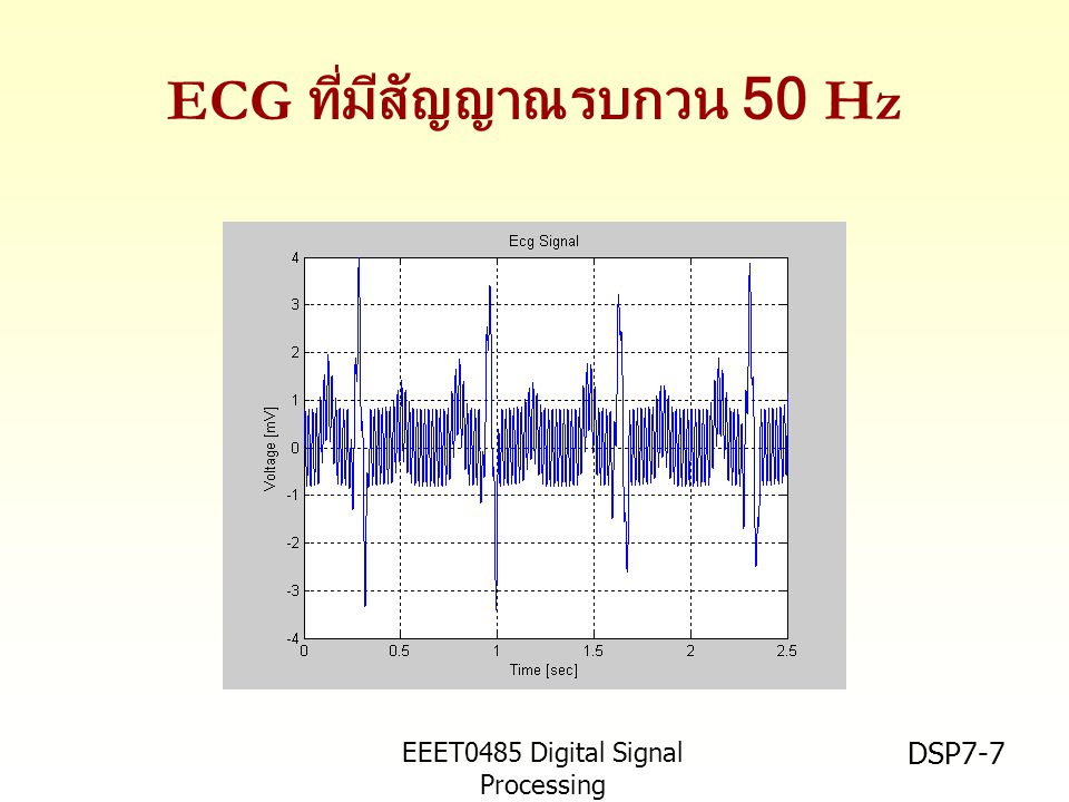 ECG ที่มีสัญญาณรบกวน 50 Hz