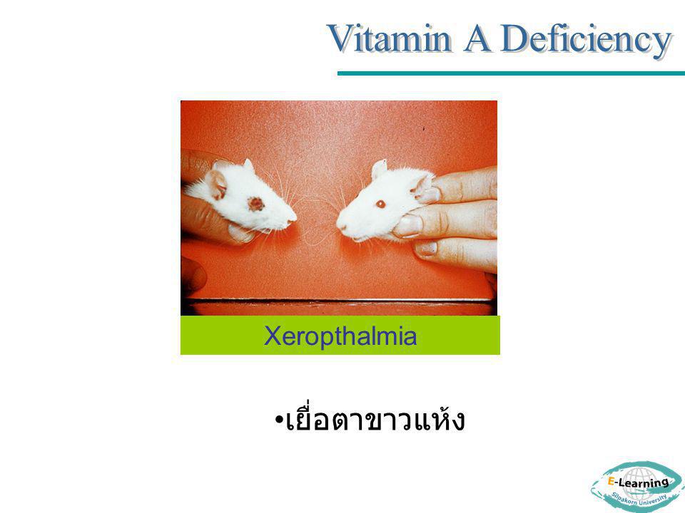 Vitamin A Deficiency Xeropthalmia เยื่อตาขาวแห้ง