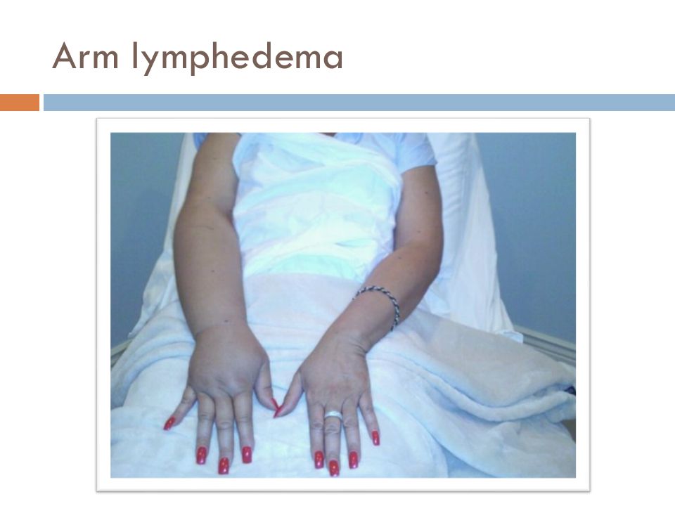 Arm lymphedema