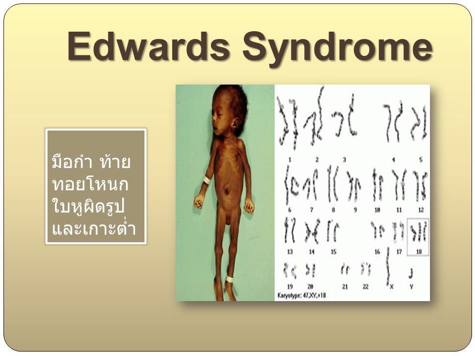 Edwards Syndrome มือกำ ท้าย ทอยโหนก ใบหูผิดรูป และเกาะต่ำ