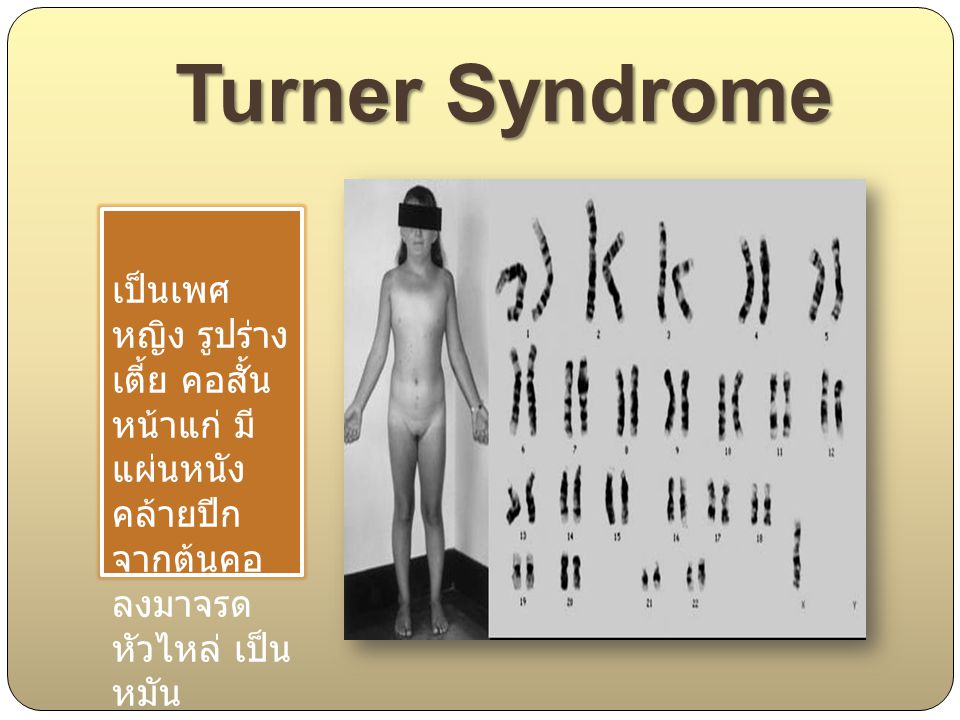 Turner Syndrome เป็นเพศ หญิง รูปร่างเตี้ย คอสั้น หน้าแก่ มี แผ่นหนัง คล้ายปีก จากต้นคอ ลงมาจรด หัวไหล่ เป็นหมัน.