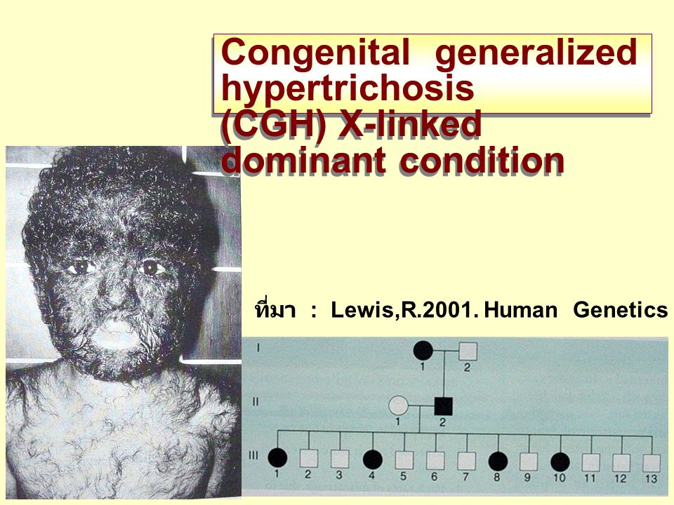 Congenital generalized hypertrichosis