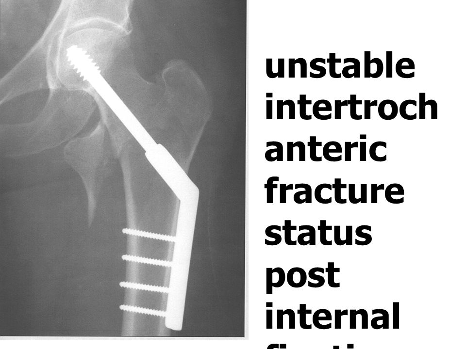 unstable intertrochanteric fracture status post internal fixation with DHS and side plate