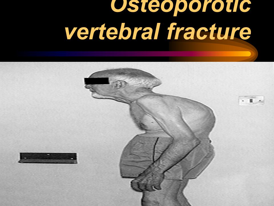 Osteoporotic vertebral fracture