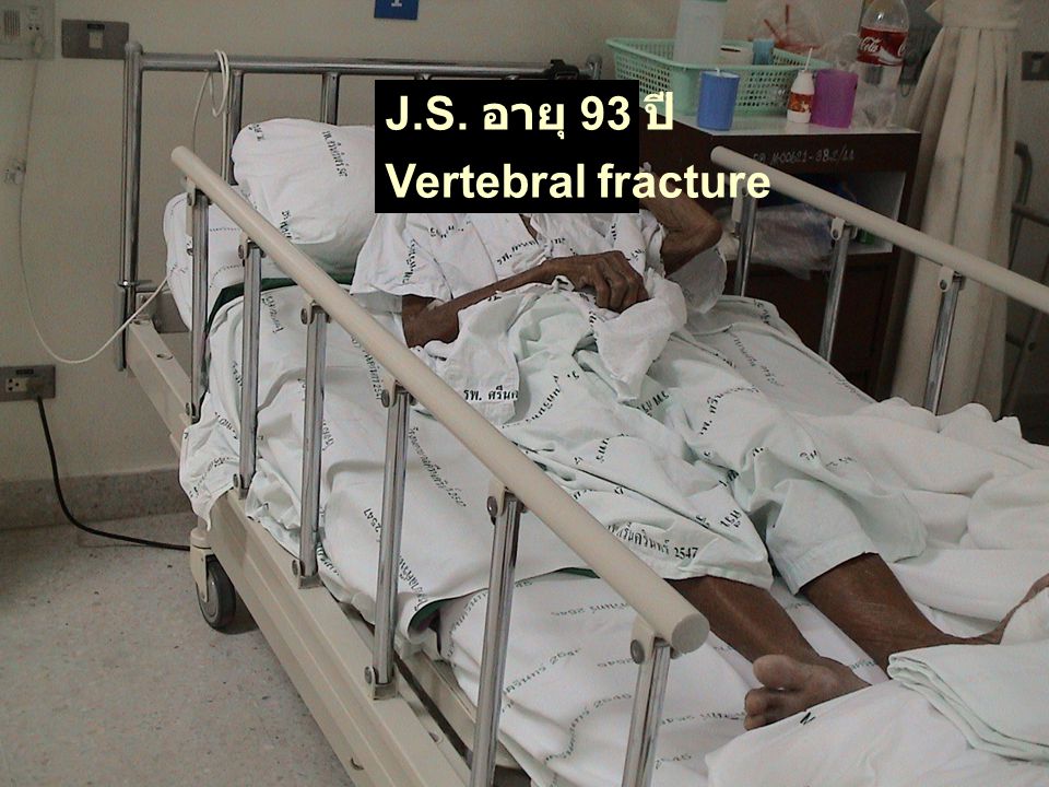 J.S. อายุ 93 ปี Vertebral fracture