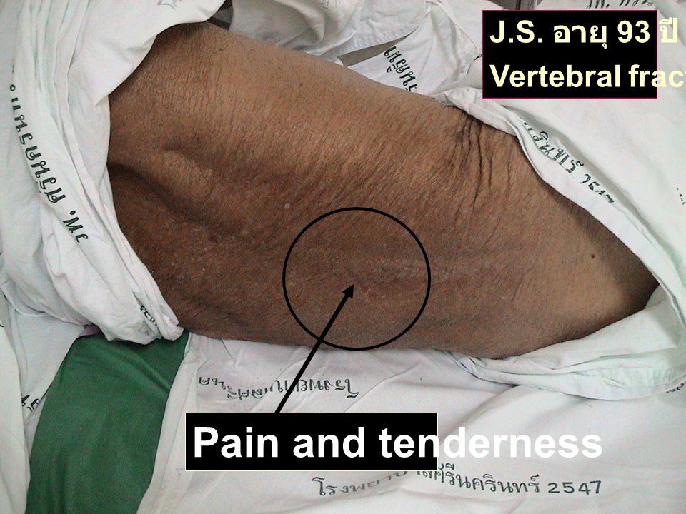 J.S. อายุ 93 ปี Vertebral fracture Pain and tenderness
