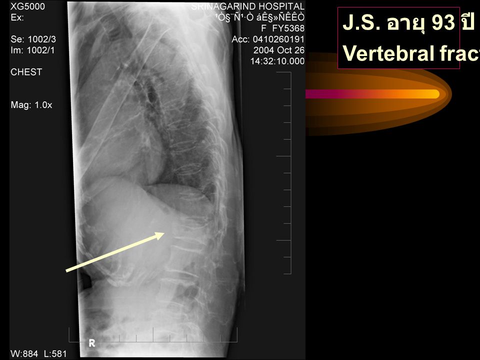 J.S. อายุ 93 ปี Vertebral fracture