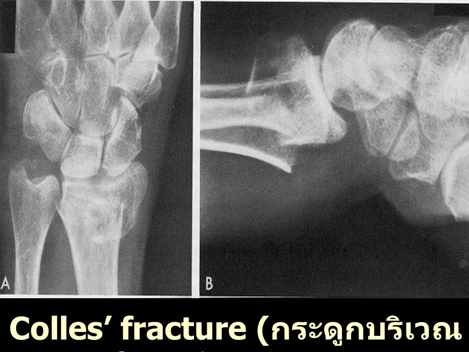 Colles’ fracture (กระดูกบริเวณปลายท่อนแขนหัก)