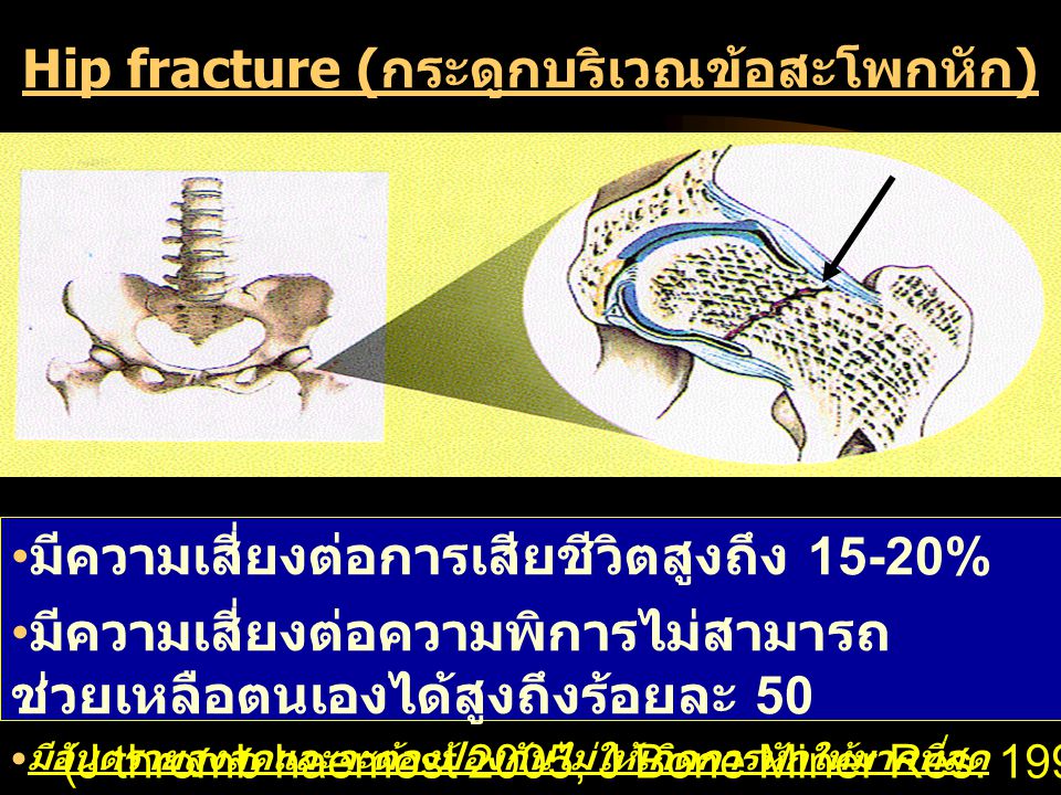 Hip fracture (กระดูกบริเวณข้อสะโพกหัก)