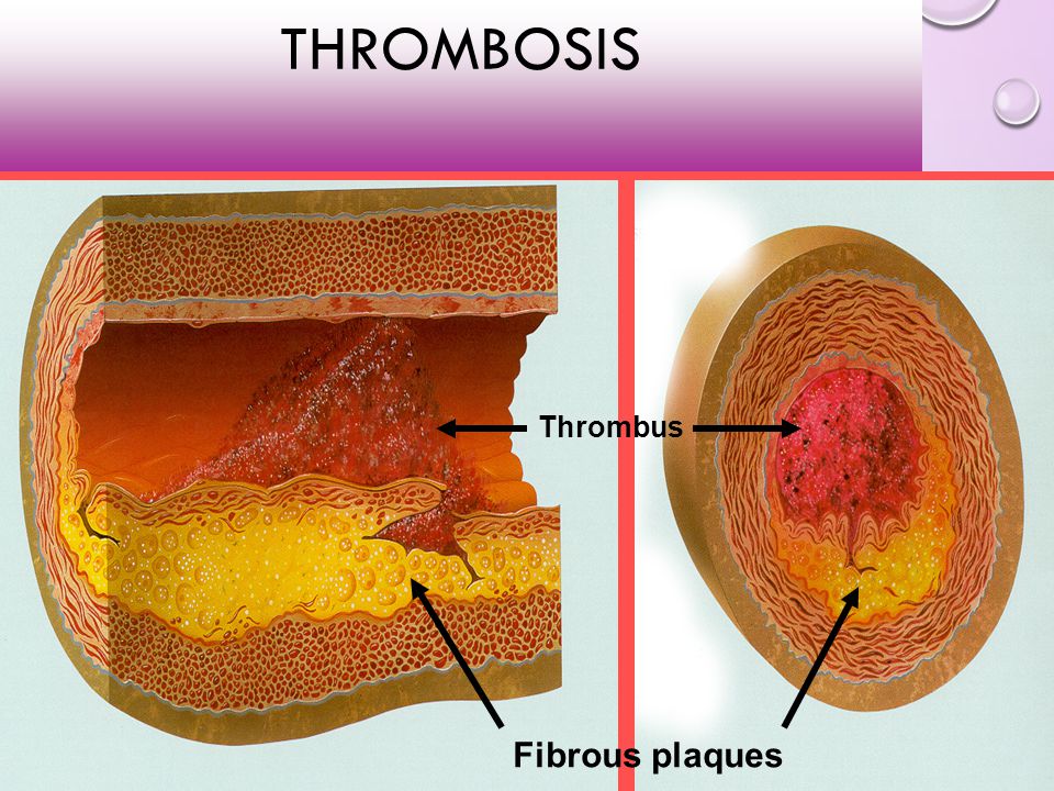 Thrombosis Thrombus Fibrous plaques