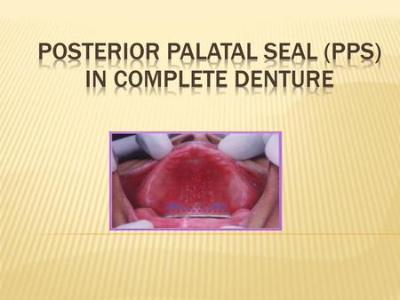 Posterior palatal seal (PPS) in complete denture