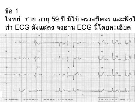 ข้อ 1 โจทย์ ชาย อายุ 59 ปี มีไข้ ตรวจชีพจร และฟังได้หัวใจเต้นไม่ส่ำเสมอ ทำ ECG ดังแสดง จงอ่าน ECG นี้โดยละเอียด.
